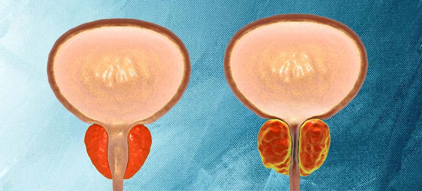 hiperplasia prostatica benigna hpb